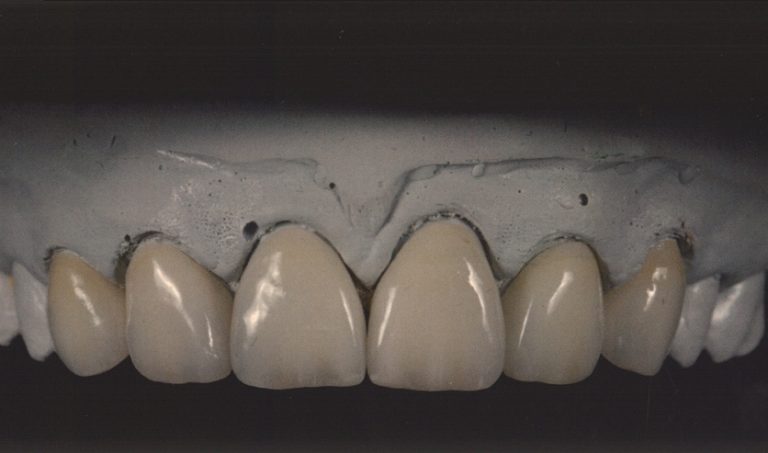 IPS-emax-1-768×453-1