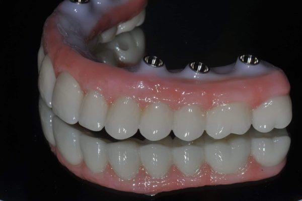 Zirconia-Dental-Implant-Teeth-qxfdx0dpsg7g5fyyc0a5yvx0jk33nid8njvp5dlz1c